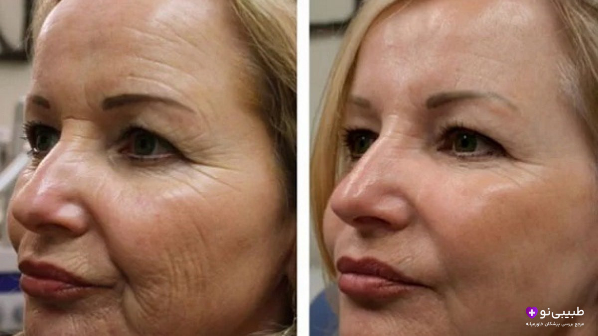  قبل و بعد لیفت صورت با لیفتینگ لیزری - کاهش چین و چروک و سفت شدن پوست صورت
