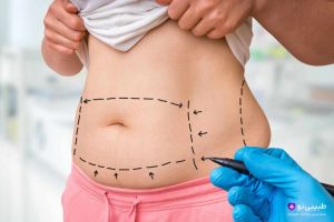 جراح با دستکش آبی در حال مارکینگ خطوط برش ابدومینوپلاستی روی شکم بیمار ؛ خطوط نقطه‌چین افقی پایین شکم (در خط بیکینی) و خطوط عمودی برای برداشت پوست اضافی و لیفت فلپ پوستی