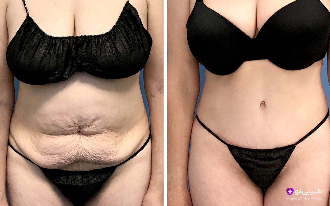 مقایسه قبل و بعد ابدومینوپلاستی: سمت چپ (قبل از عمل) پوست آویزان و شل شدید در ناحیه زیر ناف؛ سمت راست (پس از عمل) پوست کاملاً سفت، شکم صاف و تناسب طبیعی بدن بدون پوست اضافی.
