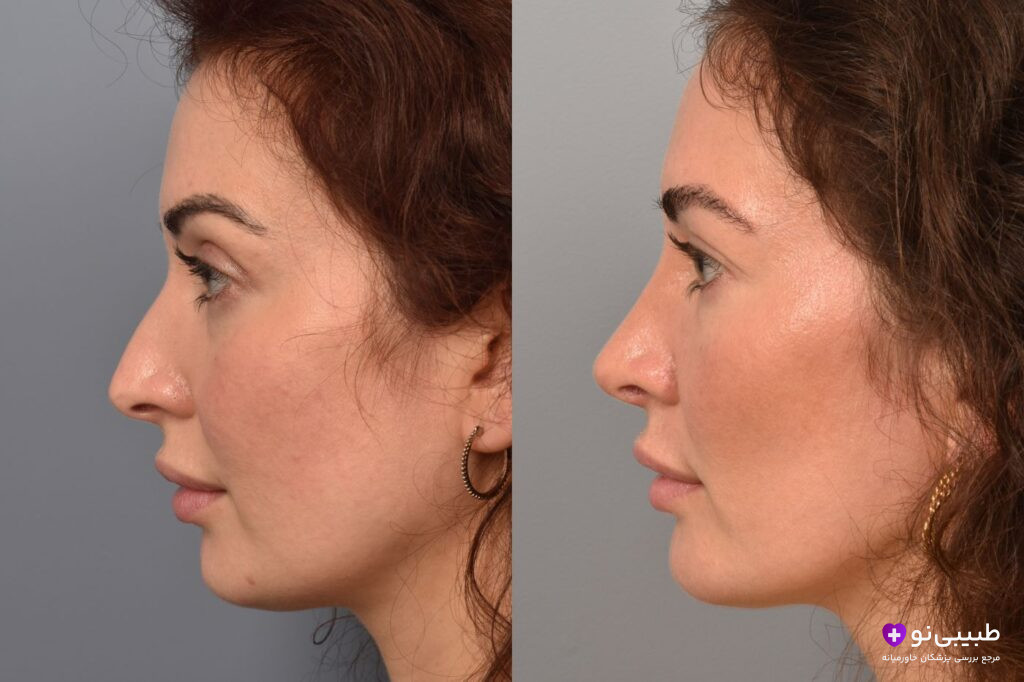 مقایسه نیمرخ قبل و چند سال بعد از بوکال فت؛ سمت چپ (قبل از عمل) گونه پرتر و خط فک نرمتر؛ سمت راست (چند سال بعد) خط فک همچنان مشخص و زاویهدار، گونه باریک و بدون بازگشت چربی بوکال، نتیجه کاملاً پایدار و طبیعی در درازمدت.