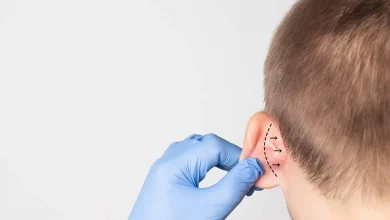 جراح با دستکش آبی در حال مارکینگ خط برش پشت گوش کودک برای اتوپلاستی؛ خطوط نقطه‌چین و فلش‌ها جهت شکل‌دهی غضروف و نزدیک کردن گوش به سر را نشان می‌دهند.