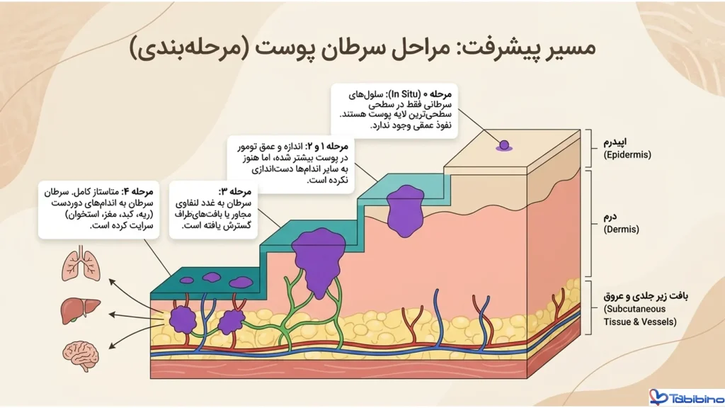 سرطان پوست گردن