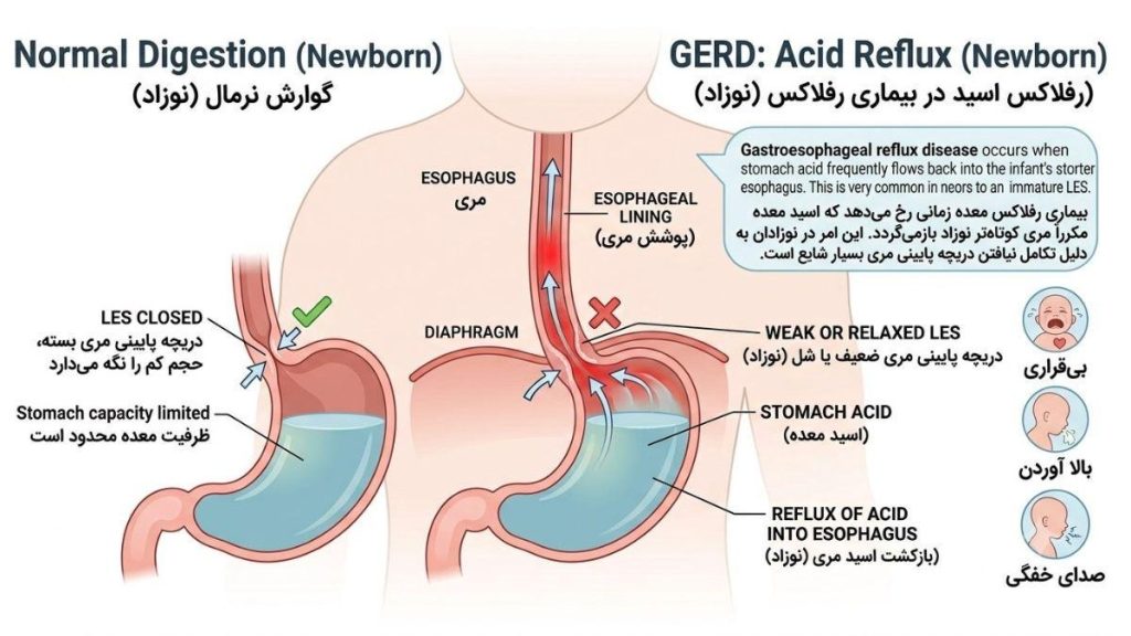تصویر دیاگرام پزشکی رفلاکس معده نوزاد که تفاوت بین عملکرد طبیعی دریچه LES و ضعف آن را نشان می&zwnj;دهد؛ مقایسه بسته ماندن دریچه و برگشت اسید معده به سمت مری.