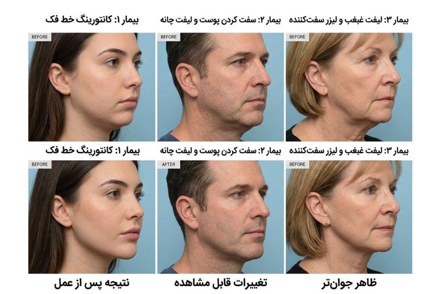 زاویه سازی فک صورت طبیبینو | تصاویر قبل و بعد از جراحی و لیفت زیبایی صورت شامل کانتورینگ خط فک، سفت کردن پوست، لیفت چانه و غبغب برای سه بیمار مختلف