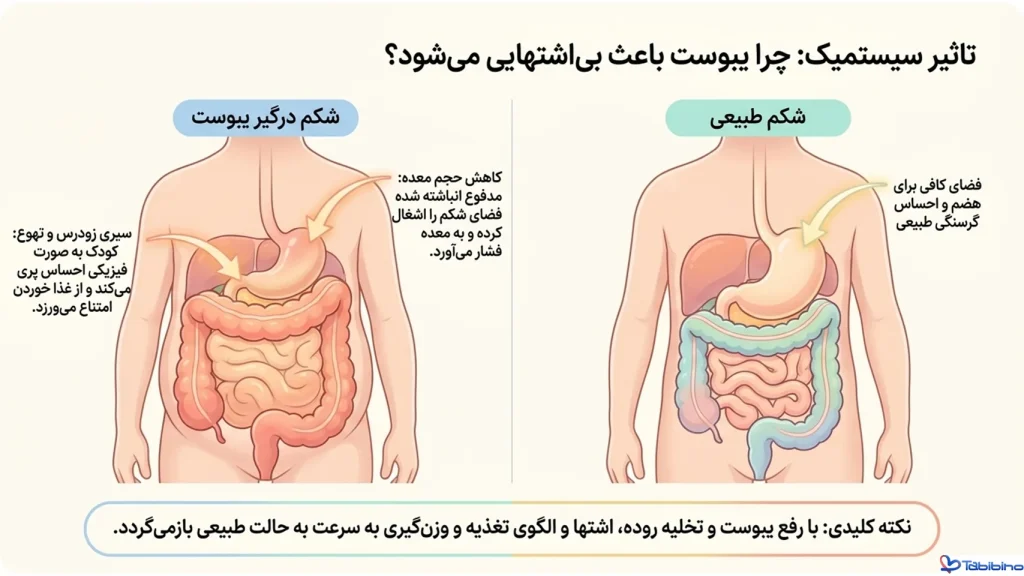 یبوست مزمن کودکان