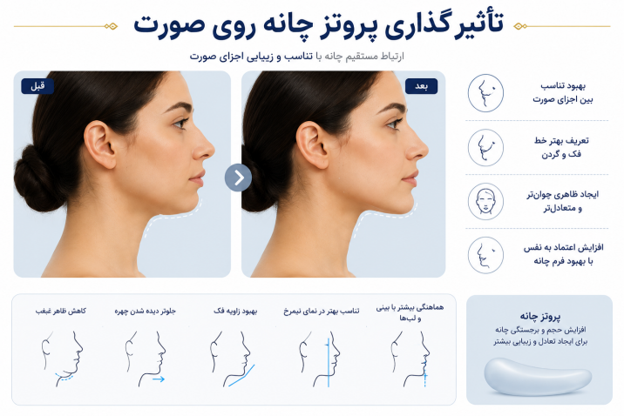 انواع پروتز چانه