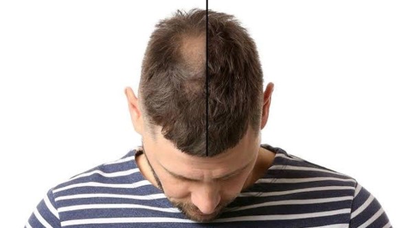 داروی فیناستراید برای ریزش مو
