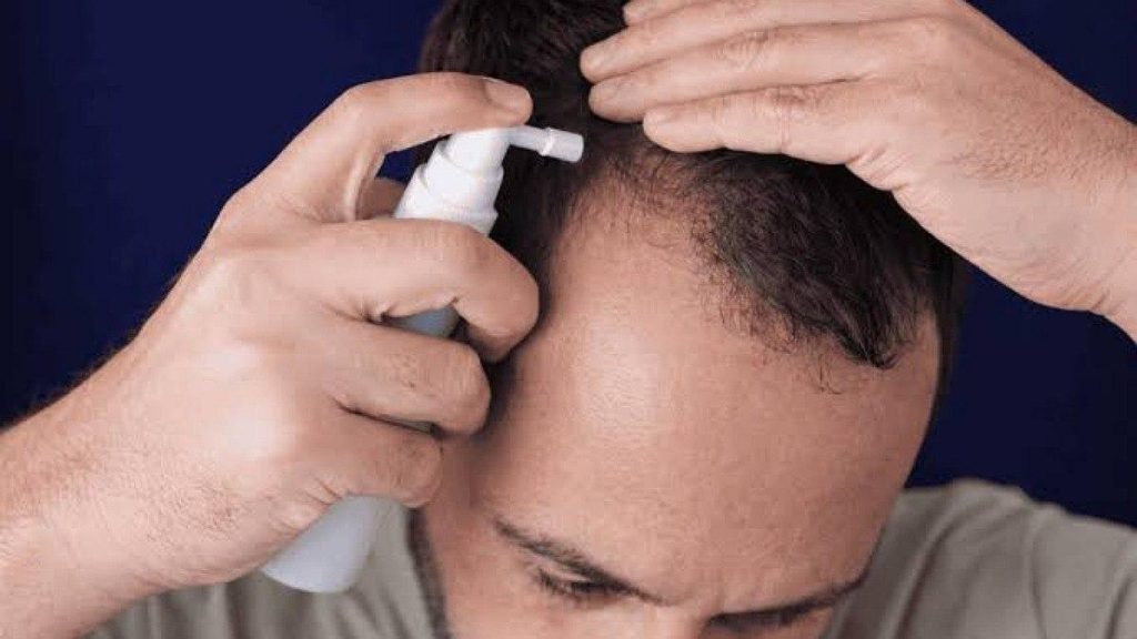 مردی در حال استفاده از محلول موضعی برای کمک به درمان ریزش مو به عنوان جایگزین فیناستراید